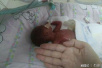 济南巴掌大双胞胎26周早产　全身透明像果冻